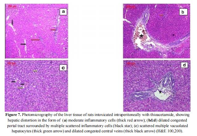  Photomicrography of the liver tissue of rats intoxicated intraperitoneally with thioacetamide, showing  hepatic distortion in the form of (a) moderate inflammatory cells (thick red arrow); (b&d) dilated congested  portal tract surrounded by multiple scattered inflammatory cells (black star); (c) scattered multiple vacuolated  hepatocytes (thick green arrow) and dilated congested central veins (thick black arrow) (H&E 100,200).